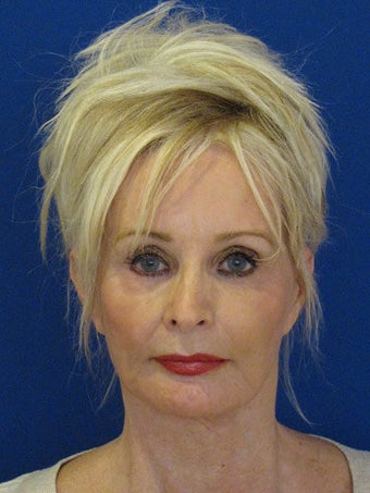 Cheeklift (minifacelift) with TCA chemical peel to the lower eyelids performed in the office under oral sedation with local anes