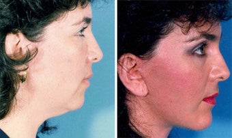 Cheek Lift and Augmentation