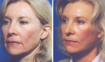Cheek Lift and Augmentation