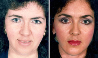 Cheek Lift and Augmentation