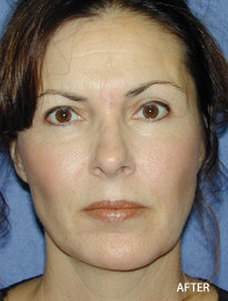 Cheek Impant Surgery
