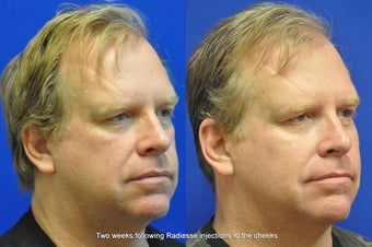 Radiesse Injection in Cheeks