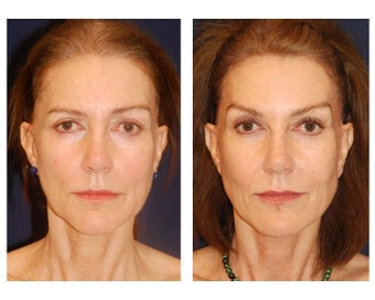 Cheek Augmentation