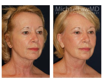 Cheek Augmentation
