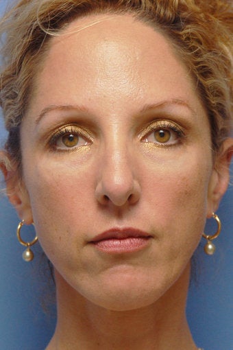 Cheek Dermafillers, Eye Dermafillers, Facial Dermafillers