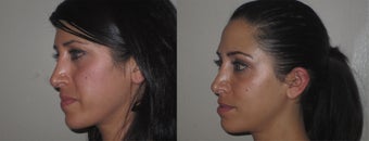 Facial Rejuvenation, non-surgical