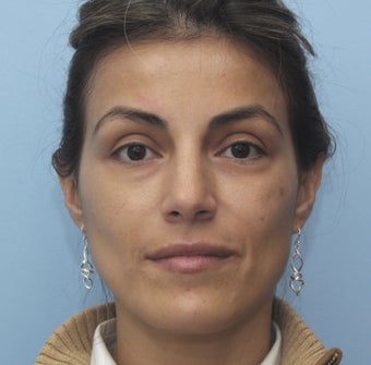 Cheek Dermafiller, Under Eye Dermafiller, Face Dermafiller