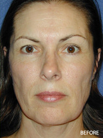 Cheek Impant Surgery