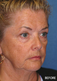 Facelift, Eyelid and Cheek Implant Surgery