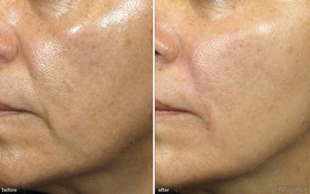 Cheek Augmentation / Cheek Lift