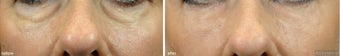 Cheek Augmentation / Cheek Lift