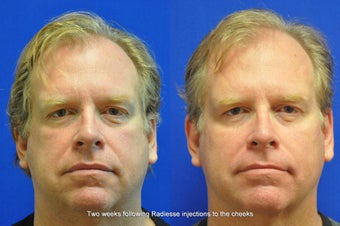 Radiesse Injection in Cheeks