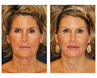 Facial Rejuvenation