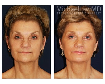 Cheek Augmentation