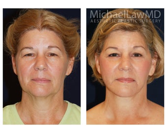 Cheek Augmentation