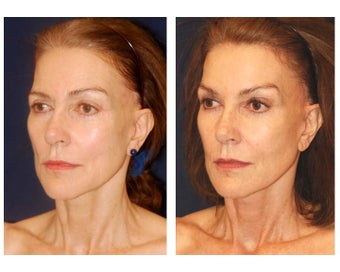 Cheek Augmentation