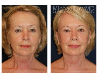 Cheek Augmentation