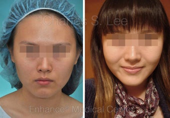 Chin Augmentation, Cheek, Jaw