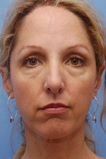 Cheek Dermafillers, Eye Dermafillers, Facial Dermafillers