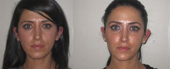 Facial Rejuvenation, non-surgical