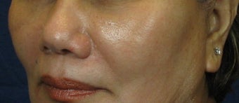 Cheek Lift / Augmentation