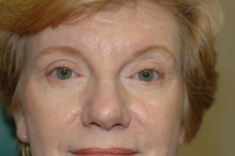 Midface Lift, upper and lower eyelid surgery