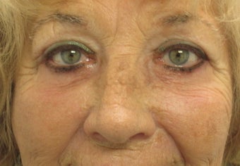 Lower Blepharoplalsty and Cheek Lift