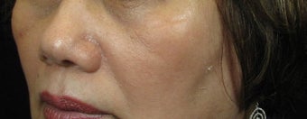 Cheek Lift / Augmentation