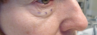 Lower eyelid and cheek lift