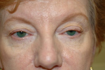 Midface Lift, upper and lower eyelid surgery