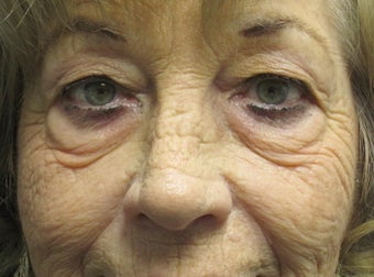 Lower Blepharoplalsty and Cheek Lift