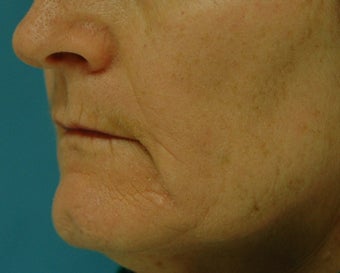 Chemical Peel