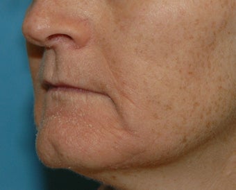 Chemical Peel