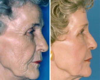 Chemical Peel
