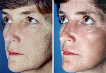 Chemical Peel