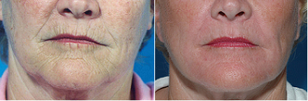 Chemical Peel