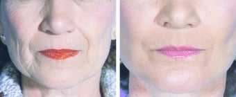 Chemical Peel 