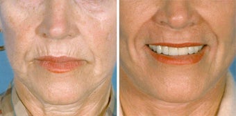 Chemical Peel