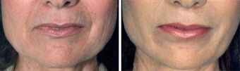 Chemical Peel
