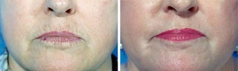 Chemical Peel