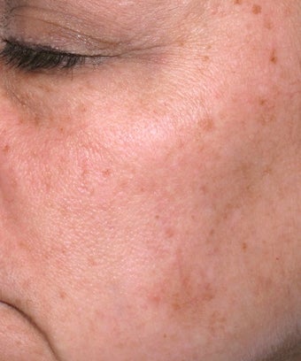 Melanage Peel to Treat Melasma and Hyperpigmentation