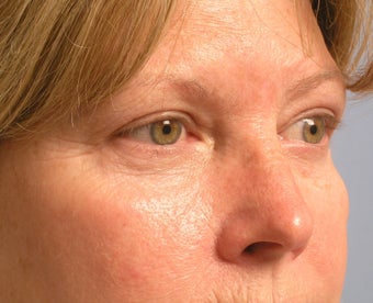 Chemical peel