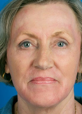 Chemical Peel 