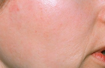 Chemical peel
