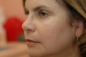 Hetter facial resurfacing