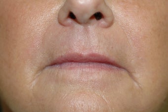 Hetter facial resurfacing