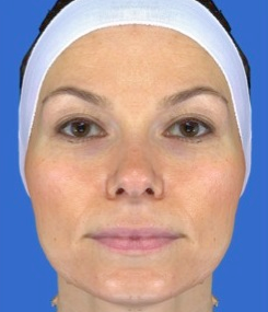 Chemical Peel