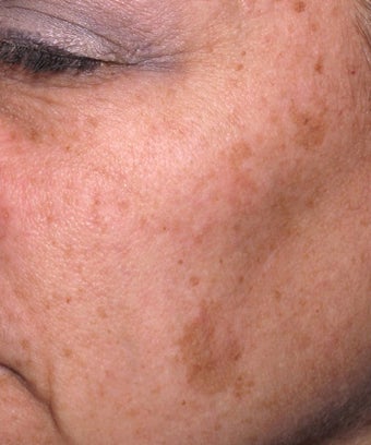 Melanage Peel to Treat Melasma and Hyperpigmentation