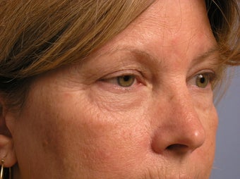 Chemical peel