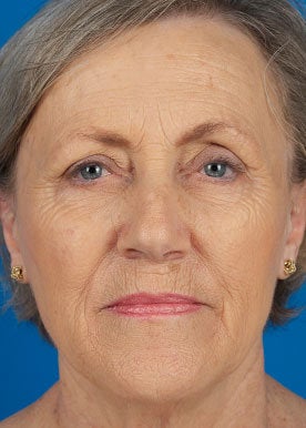 Chemical Peel 